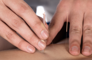 dry needling physiotherapy fleurieu physiotherapy goolwa physiotherapist