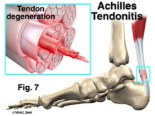 achilles tendon aches in the morning